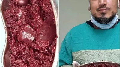 إجراء أول عملية لاستئصال طحال متضخم لطفل بتأمين بنها النموذجي