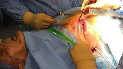 استئصال ورم أسفل الرئة اليمني لمريض مسن ببنها الجامعي (صور)