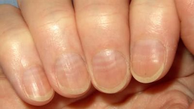 تعرف على أسباب تغيير لون الأظافر .. وعليك زيارة الطبيب في هذه الحالة!