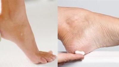 طريقة مذهلة لترطيب القدمين المتشققة (فيديو)