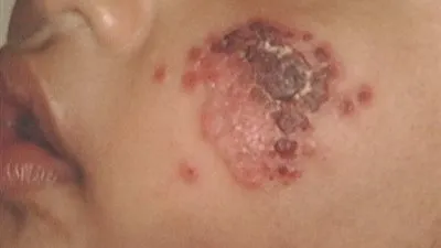 ليبيا: 5 آلاف إصابة بداء 