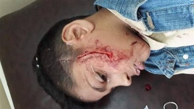 مصدر: إحالة التلميذ المتهم بتمزيق وجه زميله بسلاح أبيض لنيابة الطفل