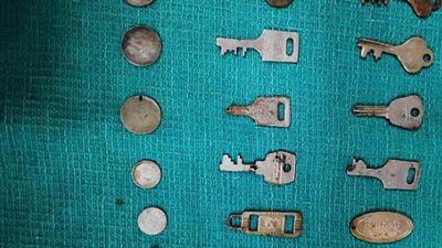 أطباء يستخرجون 40 قطعة معدنية من معدة رجل هندى