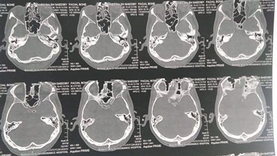 استئصال ورم دموي من جمجمة طفل 9 سنوات بتأمين بنها النموذجي (صور)
