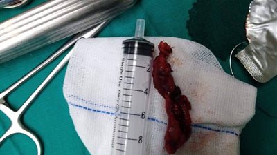 لأول مرة.. استئصال ورم سرطاني لمريض بمستشفى التأمين الصحي ببنها (صور)