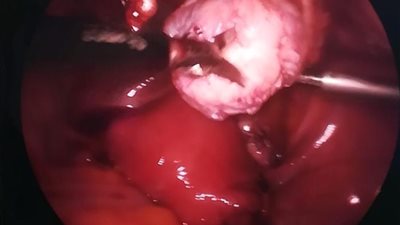  نجاح أول عملية استئصال ورم ليفي في أسيوط بفرع مستشفى جامعة الأزهر (صور)