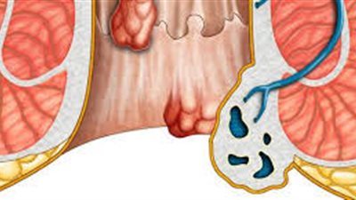 علاج البواسير في المنزل بطرق طبيعية 