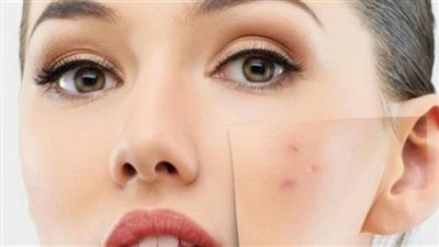 لعروس عيد الفطر.. طرق طبيعية للتخلص من حب الشباب في المنزل