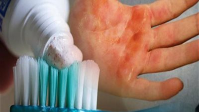 احذر استخدام معجون الأسنان في علاج الحروق