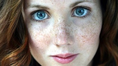 وصفات طبيعية لعلاج بقع النمش.. دربيها