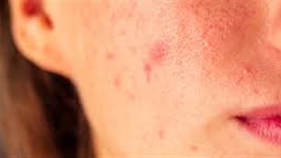 حلول سحرية للتخلص من حب الشباب نهائيا 
