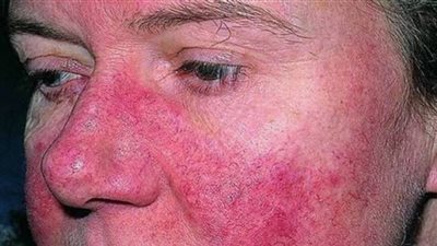 أستاذ مناعة يكشف معلومات جديدة عن 