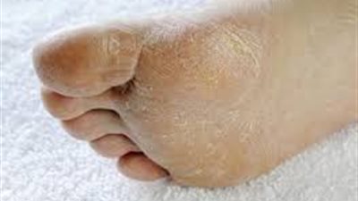 كيفية علاج تشققات القدمين؟