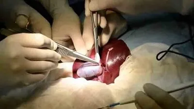 استئصال المرارة.. تعرف على الأعراض والمضاعفات