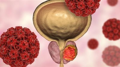 سرطان البروستاتا وطرق الوقاية منه 