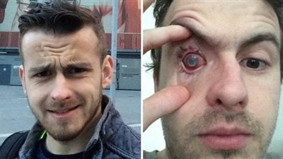 احذر.. لاعب كرة قدم فقد بصره بعد استحمامه بالعدسات اللاصقة (صور)