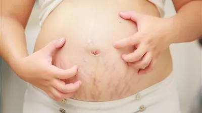 خطوات لتفادي ظهور علامات تمدد الجلد الوردية.. (تعرف عليها)