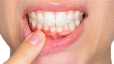 كيف تحمي فمك من التهاب اللثة؟.. أهمها الابتعاد عن التدخين