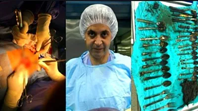 تفاصيل جديدة حول استخراج 24 ملعقة وشوكة وخاتم وسلسلة من معدة مريض