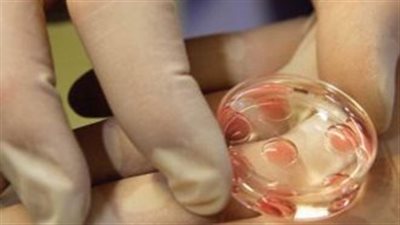 تعرف على سر إقبال الكويتيات على إجراء عمليات تجميد البويضات