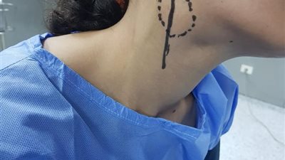 استغرقت 4 ساعات.. فريق طبي بمستشفى جامعة طنطا ينجح في استئصال ورم لفتاة (صور)