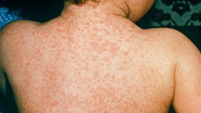 مفاجأة.. تقرير طبي يكشف إصابة طالبة بالإسكندرية بالتهاب سحائي رغم نفي الصحة