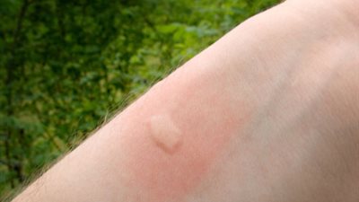 صحة البحر الأحمر تكشف حقيقة تفشي مرض 