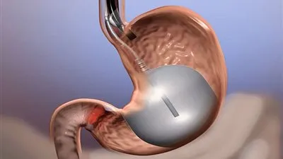 فوائد عملية بالون المعدة Stomach Balloon وأضرارها.. هؤلاء عليهم الحذر من إجرائها!