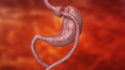 دليلك الكامل حول عملية تجاوز المعدة Gastric bypass بطريقة 