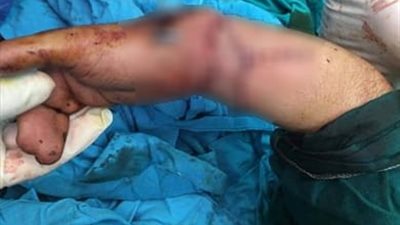 فريق  جراحي بمستشفى الطوارىء يتمكن من إعادة يد شاب بعد قطعها بصاروخ سراميك 
