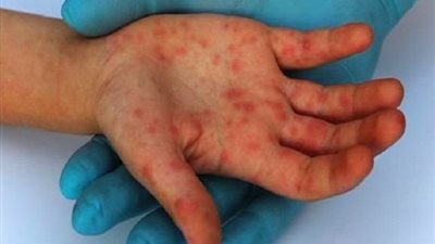 إصابة طالب بفيروس الحصبة بإحدى مدارس مكة