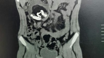 استخراج جنين من بطن طفل في الإسكندرية (صور)