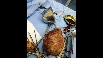 استخراج 3 حصوات تزن نصف كيلو من مريض بقنا