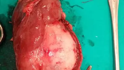 لأول مرة.. استئصال ورم سرطاني لسيدة في الإسكندرية