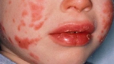 بعد الكورونا.. مرض خطير يصيب الأطفال