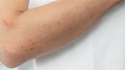 هل الطفح الجلدي من أعراض كورونا؟ هاني الناظر يجيب (فيديو)