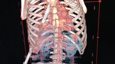 فريق طبي بمستشفى جامعة طنطا يستخرج 