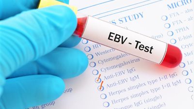 احذر.. ينتقل عن طريق السعال والتقبيل.. ما هو فيروس إبشتاين بار EBV؟