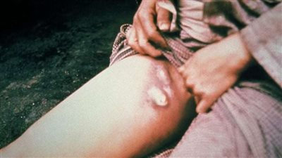 الطاعون الدبلي.. 8 معلومات عن الوباء الجديد بالصين(فيديو)