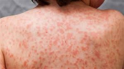 بعد نفي مجلس الوزراء.. ماهو مرض 