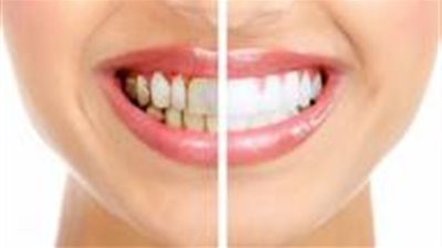 أبرزها الليمون.. وصفات لتبييض الأسنان في دقائق