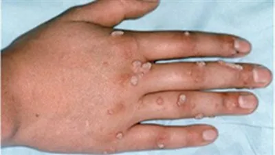 تصدر جوجل.. الورم الحليمي فيروس خطير يصيب الإنسان بسبب الجنس