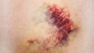 ماذا تعرف عن مرض الهيموفيليا؟