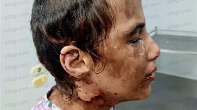 كلور ومياه ساخنة.. مفاجآت صادمة في تعذيب طفلة على يد زوج وزوجته بالغربية (صور)