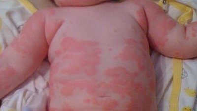 له أشكال متعددة.. عودة مرض نادر وخطير يصيب الأطفال (تعرف عليه)