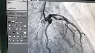 مريض كان على وشك الموت.. معجزة إلهية بمستشفى المنصورة العام