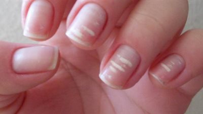 بدون مسحة.. طبيب جلدية: علامة باليد تُشير للإصابة بكورونا