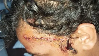 لدفاعه عن فتاة.. بلطجية يشوهون وجه شاب بـ17 غرزة في الغردقة