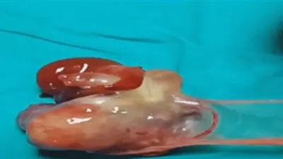 تعرف على تفاصيل استخراج جنين من بطن رضيعة عمرها 7 أيام