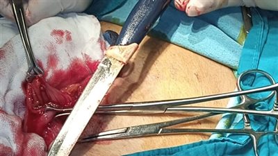 مدير مستشفى المنصورة الدولي يكشف تطورات حالة الشاب الذي ابتلع 